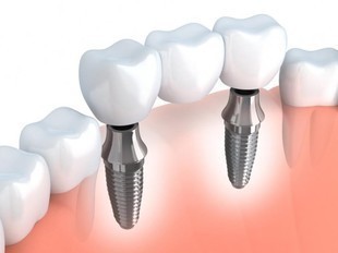 Wszystko o implantach