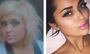 Gwiazdy Instagrama przed i po operacjach plastycznych