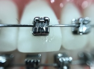 7 mitów związanych z leczeniem ortodontycznym