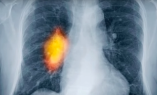 9 objawów raka płuc