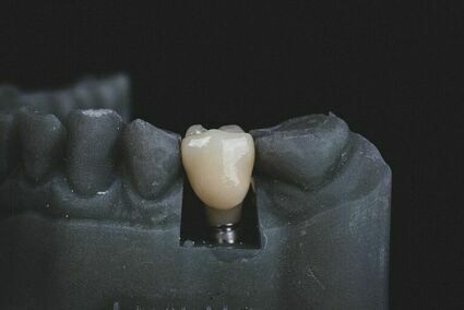 Gdzie najlepiej zrobić implanty zębów?