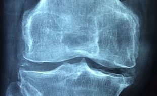 Osteoporoza to zaniedbany problem, który dotyczy ok. 3 mln Polaków