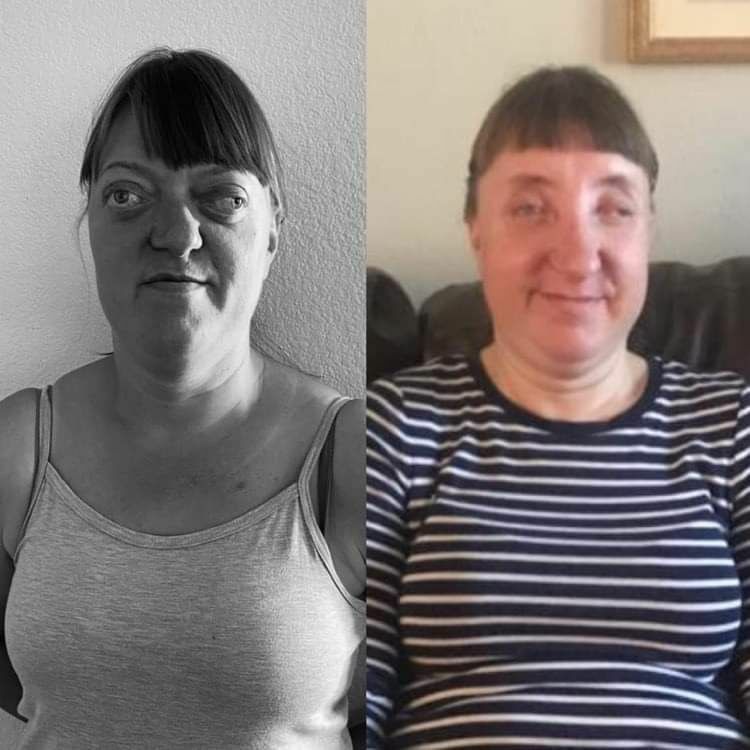 Ewa przed i po operacji.