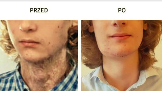 Dominik przed i po operacji